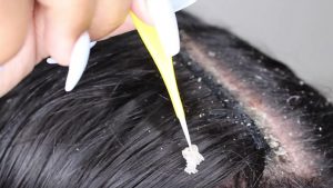 المعهد الذهبي | أمراض الشعر الشائعة وطرق علاجها طبيعيا