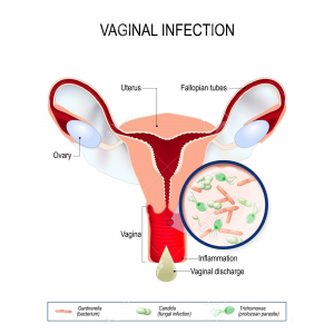 المعهد الذهبي|نصائح وخطوات للتقليل من مونيليا المهبل (الكانديدا)90420767-la-vaginitis-es-una-inflamación-de-la-vagina-infección-vaginal-y-agentes-causantes-de-vulvovaginitis-gardn