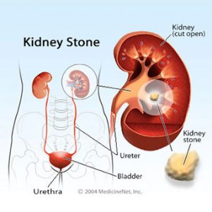 المعهد الذهبي|وصفات طبيعية لعلاج حصيات الكلى والحالبkidney-stones-s2-illustration