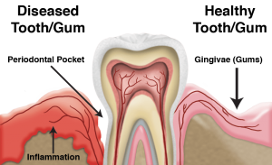 المعهد الذهبي|نصائح مفيدة لمتاعب الأسنان واللثةperio