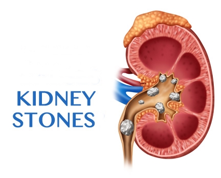 المعهد الذهبي|وصفات طبيعية لعلاج حصيات الكلى والحالبpost-kidney-stones