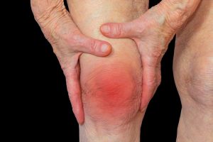 المعهد الذهبي|نصائح وأغذية طبيعية لعلاج التهاب المفاصلrheumatoid-arthritis-knee
